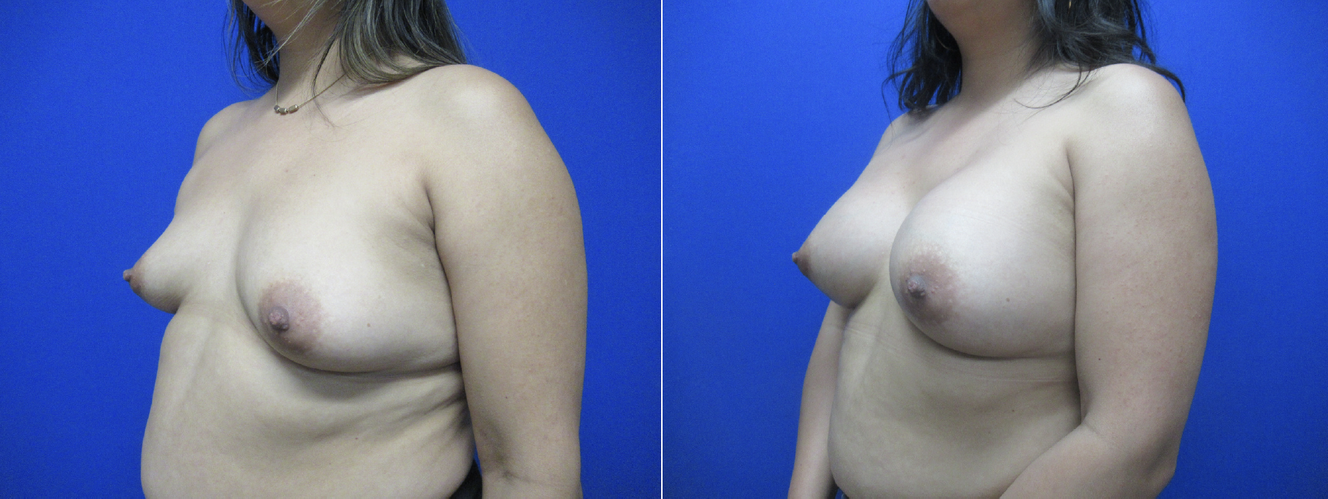 Breast Augmentation Before and After